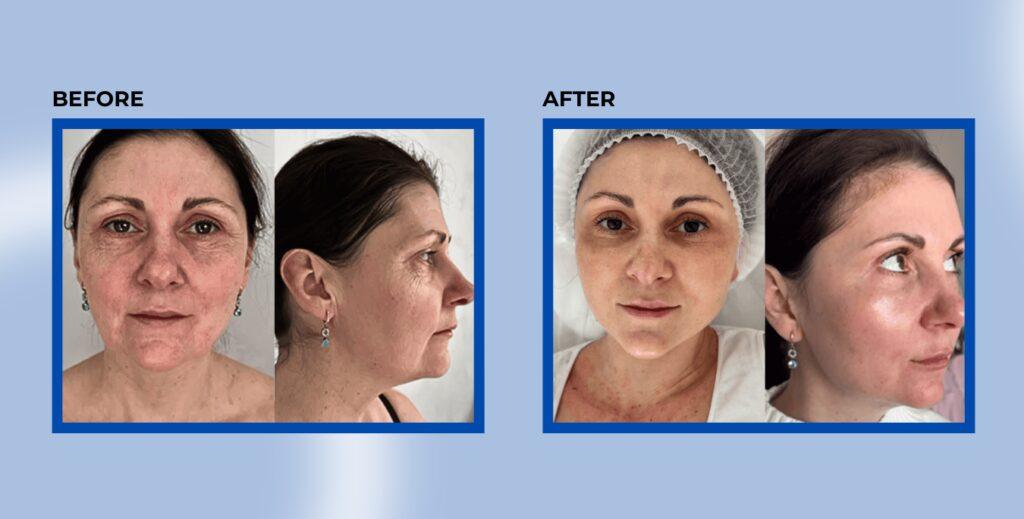 before&after