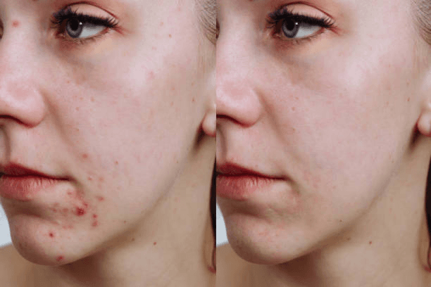 Micro-damage to the skin, such as post-acne, decreased by 7.3%