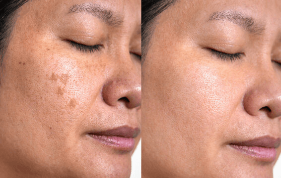 Severity of hyperpigmentation decreased by 5.6%