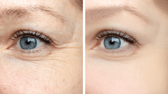 The number of fine wrinkles caused by muscle contractions decreased by 18.3%