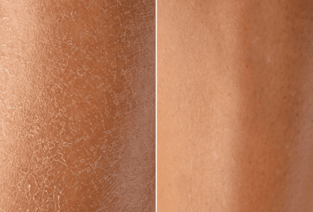 The activity of antioxidant mechanisms in the dermis increased by 11.2%