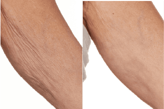 The levels of the skin's main structural proteins, collagen and elastin, increased by 21.3%