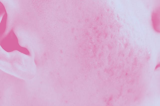 Aftereffects of acne and pimples