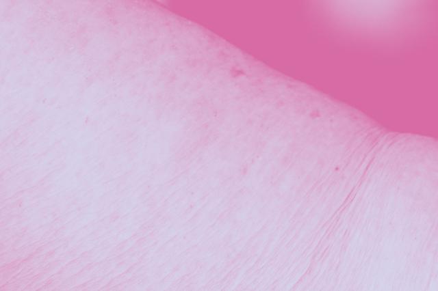 Loss of elasticity and sagging skin on the body