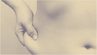Excessive fat deposits
in the abdomen, buttocks, thighs or waist.