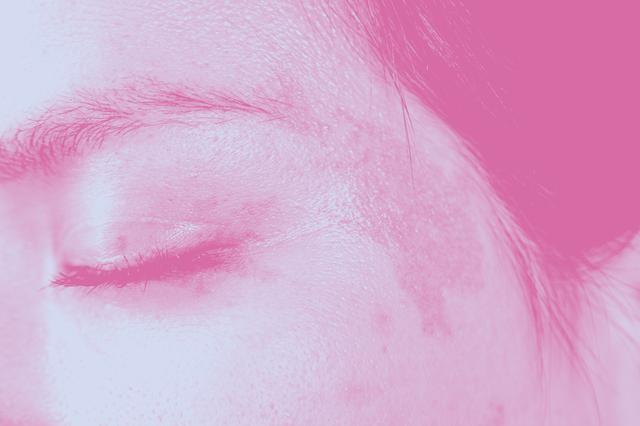 Photoaging and pigmentation